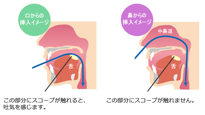 胃部内視鏡検査　経口と経鼻